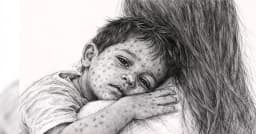 ২৪ ঘণ্টায় হাম ও হামের উপসর্গ নিয়ে আরও ৭ শিশুর মৃত্যু