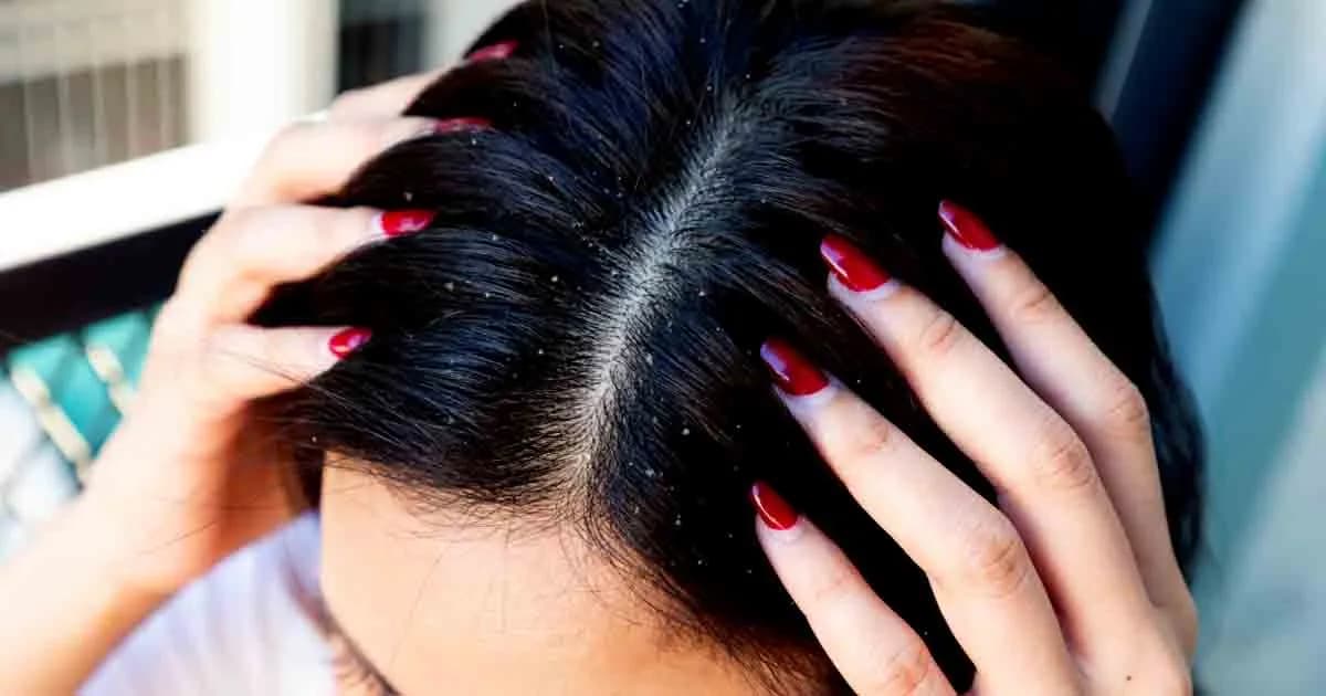 খুশকি দূর করতে শুধু শ্যাম্পুই যথেষ্ট নয়