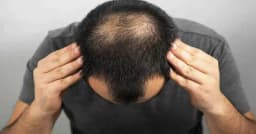 পুরুষদের অতিরিক্ত চুল পড়ার নেপথ্যে যে ৫টি দৈনন্দিন অভ্যাস