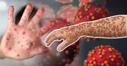 ২৪ ঘণ্টায় হাম ও হামের উপসর্গে আরও ৭ জনের মৃত্যু