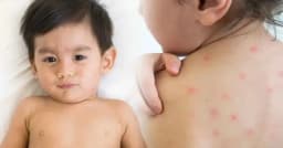 হামের উপসর্গ নিয়ে বরিশালে আরও দুই শিশুর মৃত্যু