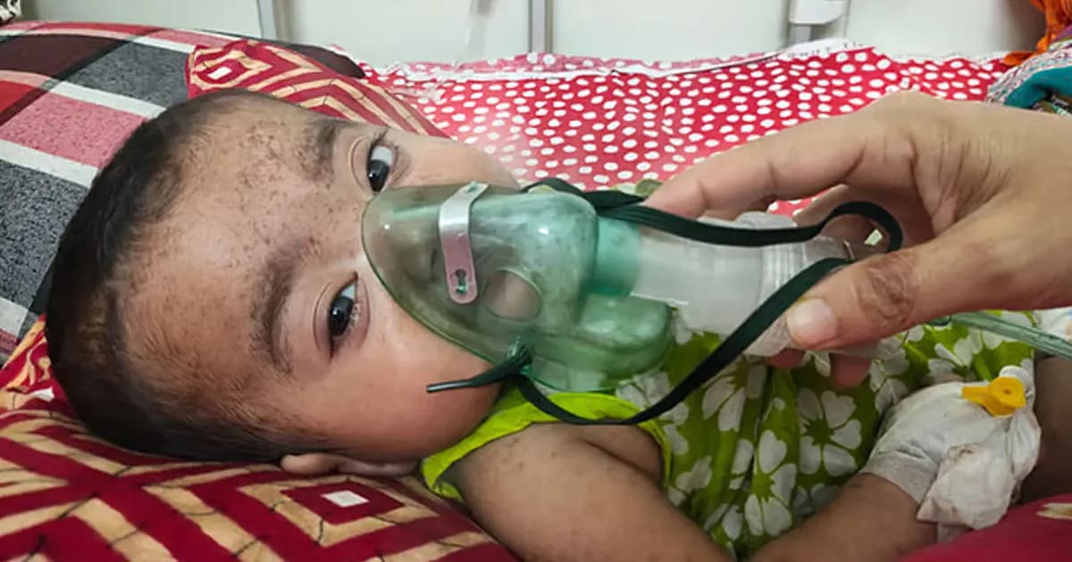 হামের উপসর্গে আরও ৫ শিশুর মৃত্যু, নতুন করে আক্রান্ত ১,৪৪৮