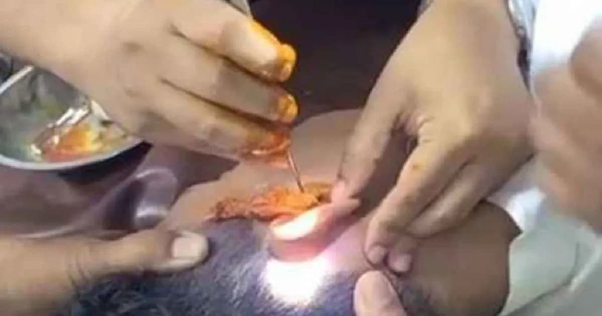 পুলিশের তল্লাশি এড়াতে কানে ইয়াবা, অতঃপর অস্ত্রোপচারে উদ্ধার