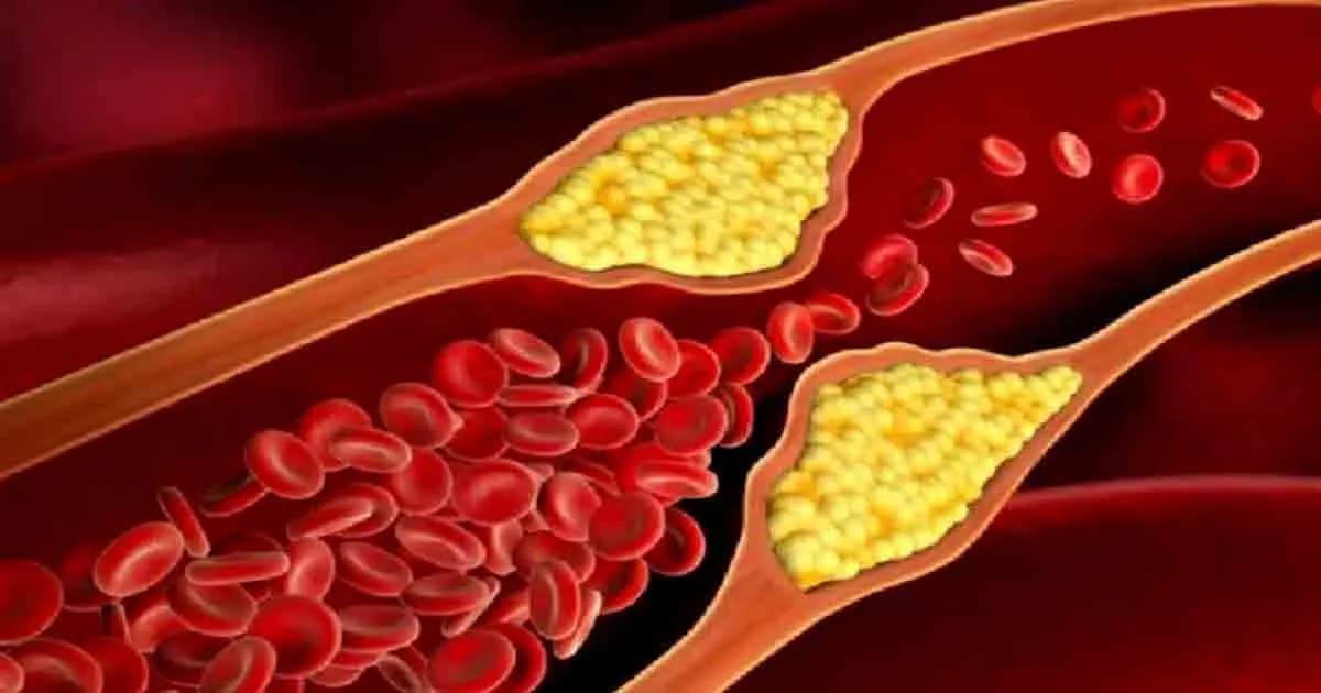 অতিরিক্ত কোলেস্টেরল কমানোর সহজ উপায়