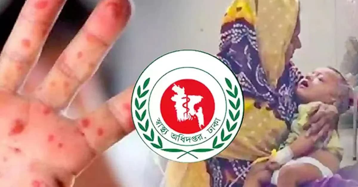 হাম উপসর্গে আরও ৬ জনের মৃত্যু, নতুন আক্রান্ত ১,৪০৮