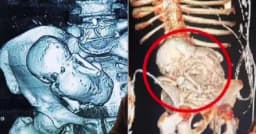 প্রসবের ভয়ে হাসপাতাল ছাড়েন, ৩৬ বছর পর পেটে মিলল ‘পাথর শিশু’