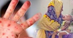 থামছে না মৃত্যুর মিছিল, হামের উপসর্গে ঝরল আরও ৯ শিশুর প্রাণ