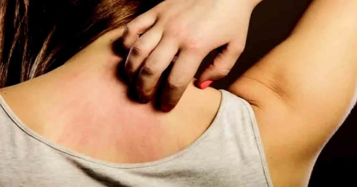 চুলকানি হতে পারে মারাত্মক রোগের লক্ষণ