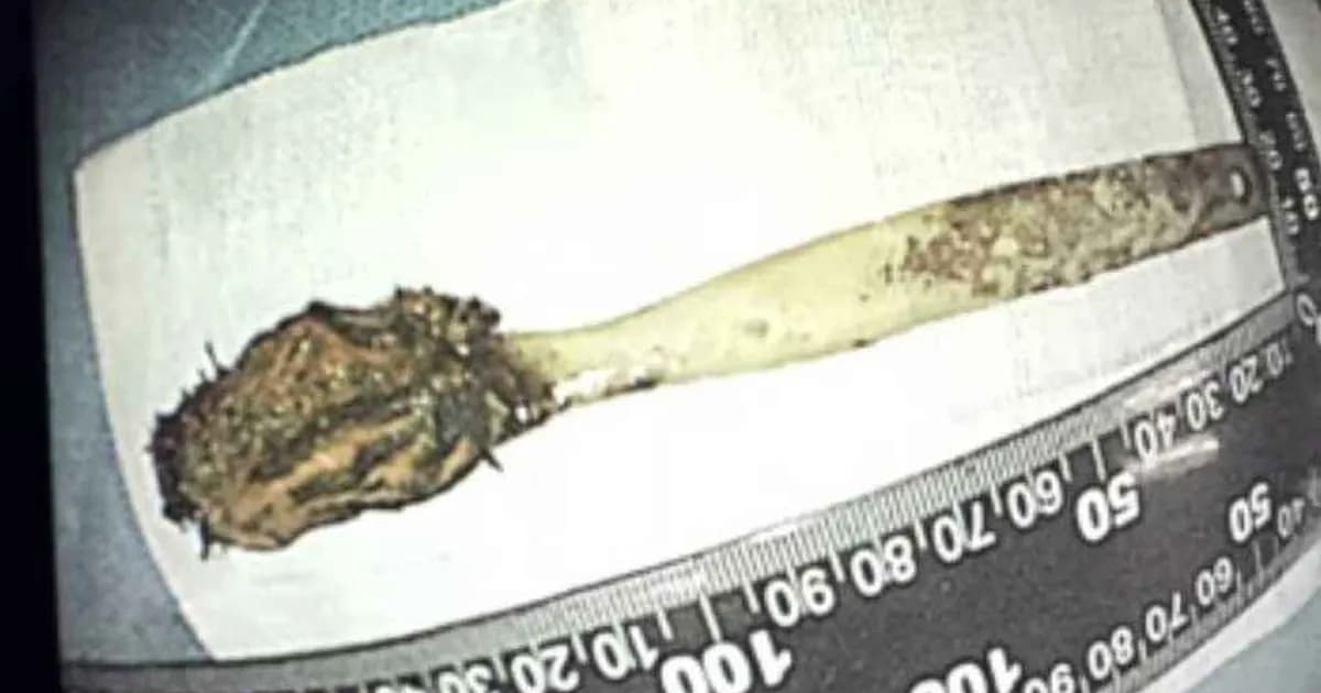 ব্যথা নিয়ে হাসপাতালে যুবক, ২০ বছর পর পেটে মিলল থার্মোমিটার