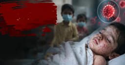 হামের ভয়াবহ বিস্তার: ২৬ দিনে প্রাণ গেল ১৬৬ শিশুর