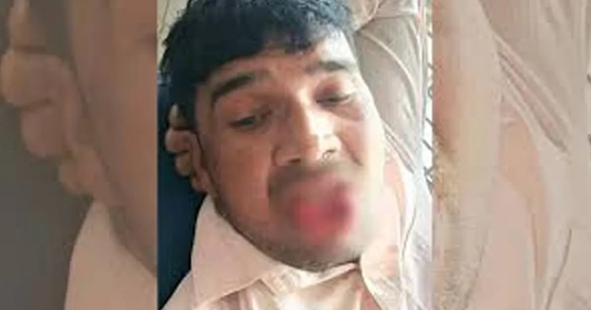 কামড়ে প্রেমিকের জিহ্বা ছিঁড়ে ফেললেন তরুণী