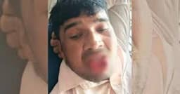 কামড়ে প্রেমিকের জিহ্বা ছিঁড়ে ফেললেন তরুণী