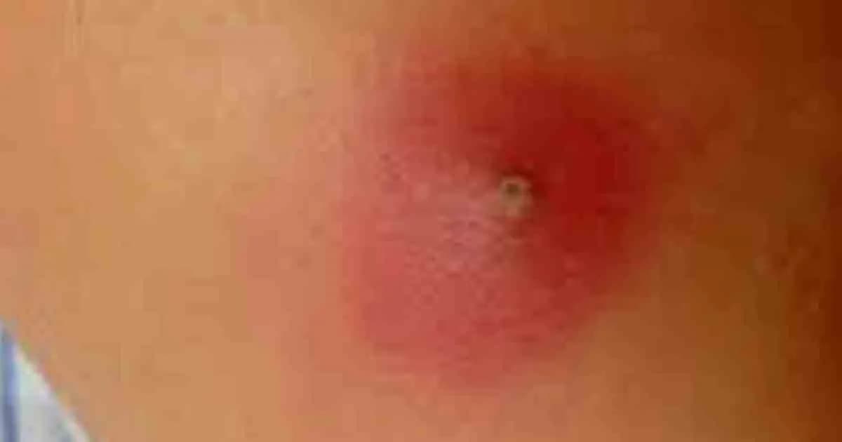 ত্বকে বিষফোঁড়া কেন হয়, জেনে নিন সমাধান