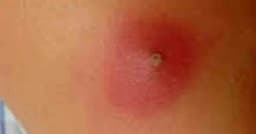 ত্বকে বিষফোঁড়া কেন হয়, জেনে নিন সমাধান