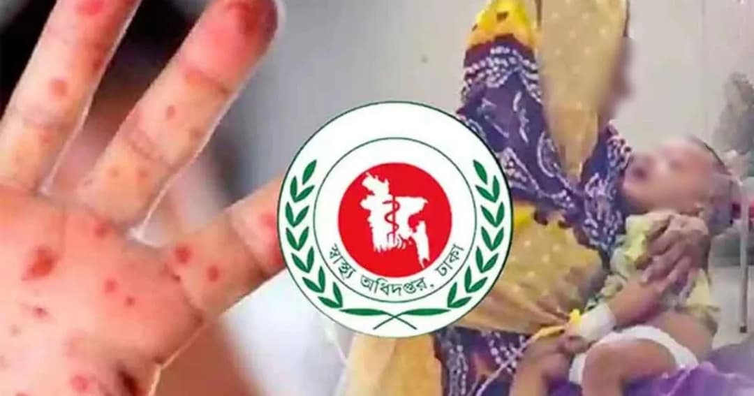 ২৪ ঘণ্টায় হামের উপসর্গ নিয়ে আরও ৭ শিশুর মৃত্যু