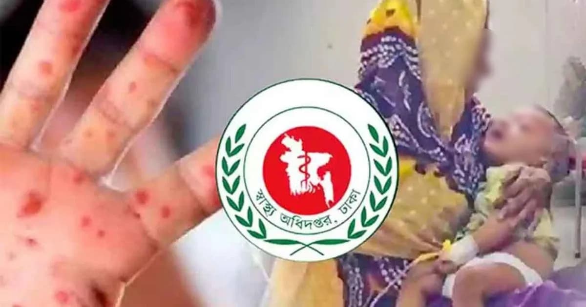হাম উপসর্গ নিয়ে মৃত্যু ৭০০ ছাড়ালো, একদিনে আক্রান্ত ৯৭৬