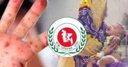 হাম উপসর্গ নিয়ে মৃত্যু ৭০০ ছাড়ালো, একদিনে আক্রান্ত ৯৭৬