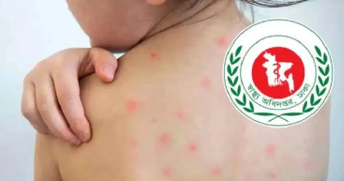 হাম ও উপসর্গে আরও ২ জনের মৃত্যু, হাসপাতালে ভর্তি ১ হাজার ৪২১