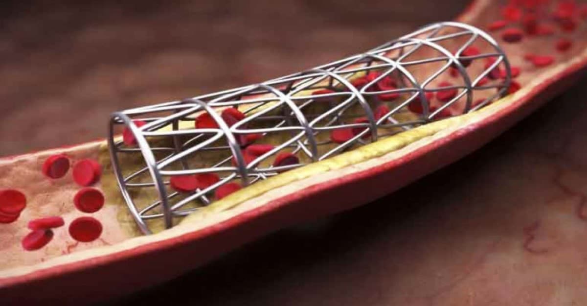 ২৩ ধরনের হার্টের রিংয়ের দাম কমলো