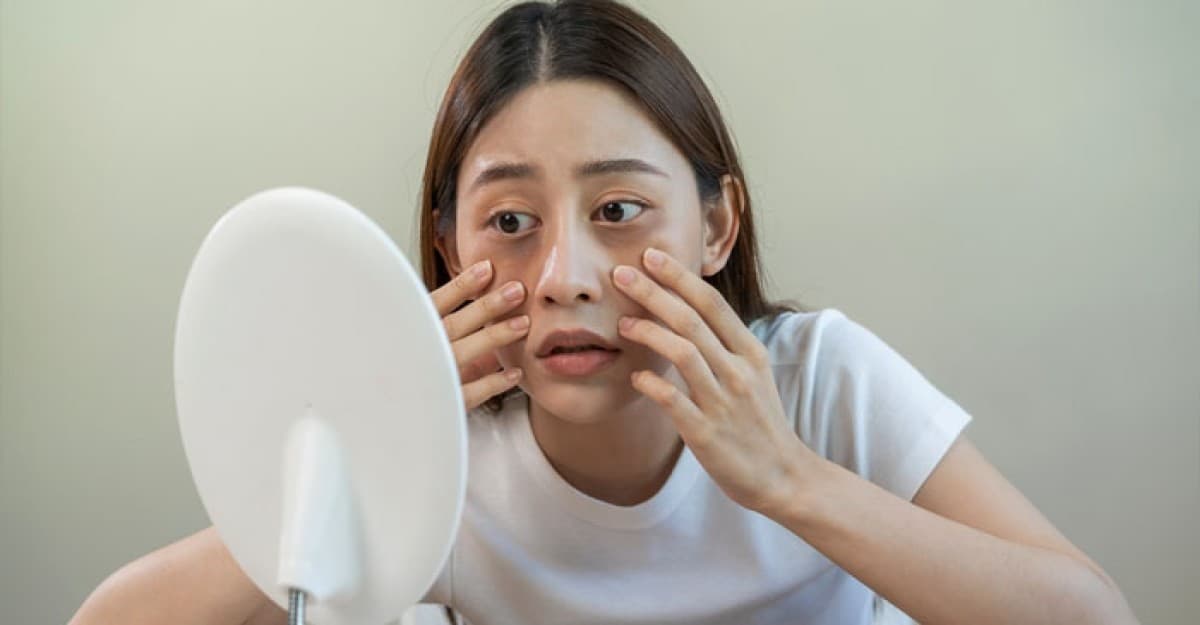 যেসব সবজিতে দূর হবে চোখের নিচের কালি ও ব্রণের দাগ