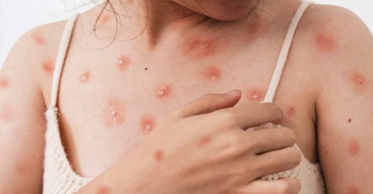 মাঙ্কিপক্স কী? কীভাবে ছড়ায়?