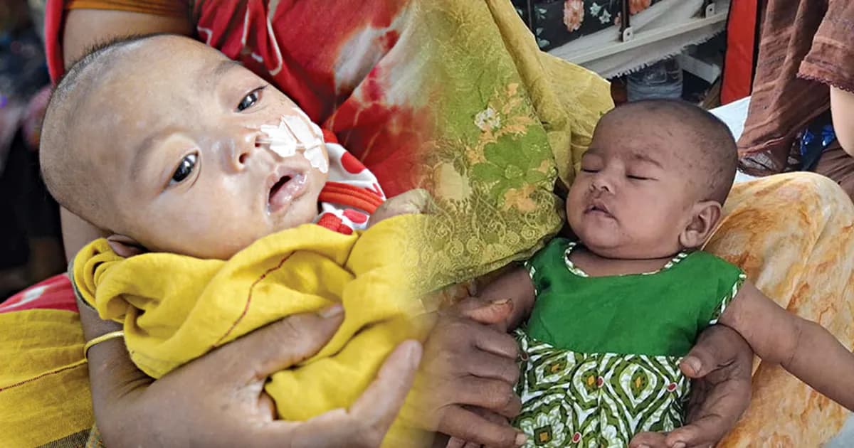 দেশজুড়ে নতুন আতঙ্ক ‘হাম’, টিকা নিয়েও আক্রান্ত হচ্ছে শিশুরা