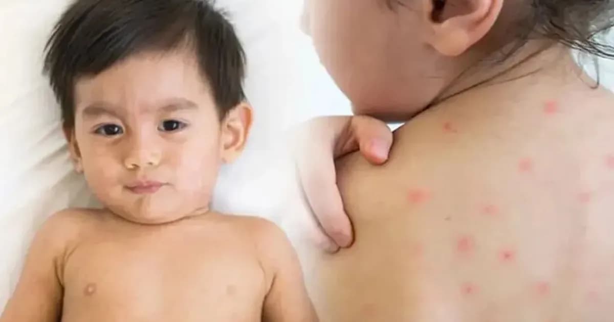 হামের উপসর্গ নিয়ে বরিশালে আরও দুই শিশুর মৃত্যু