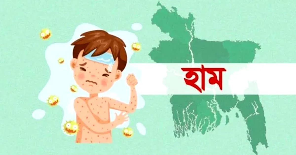হাম ও হামের উপসর্গে ৪৯৯ জনের মৃত্যু, ঢাকায় ২১০