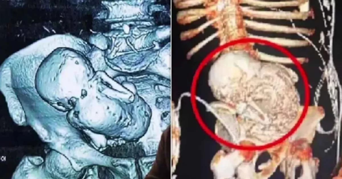 প্রসবের ভয়ে হাসপাতাল ছাড়েন, ৩৬ বছর পর পেটে মিলল ‘পাথর শিশু’