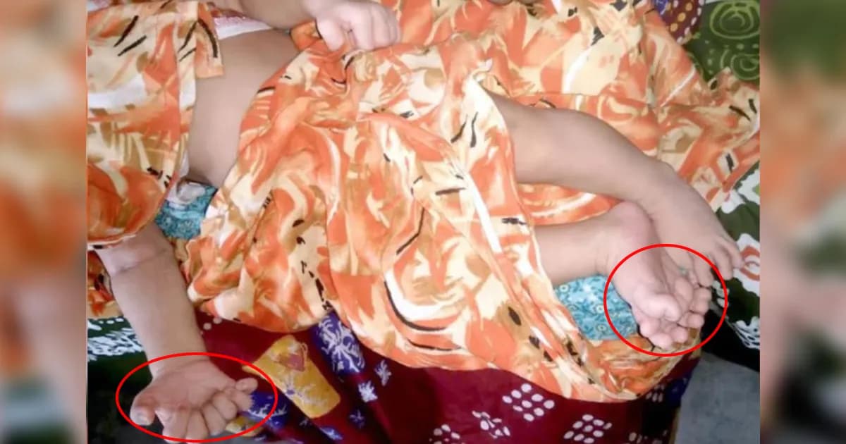 দিনাজপুরে ২৮ আঙুল নিয়ে কন্যাশিশুর জন্ম!