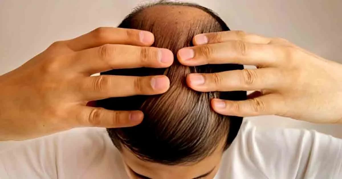 চুল পড়া কমান ঘরোয়া কিছু উপায়ে