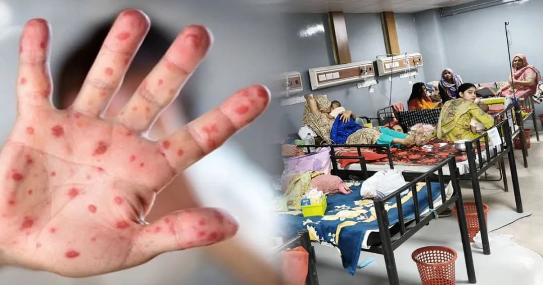 মহামারি আকার নিচ্ছে হাম, আইসিইউ সংকটে মৃত্যু-মিছিলের ঝুঁকি