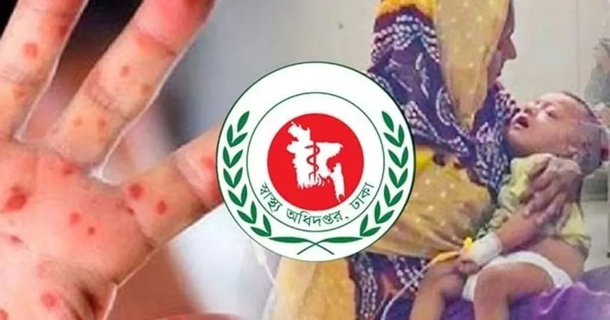 হামের উপসর্গ নিয়ে আরও ৮ জনের মৃত্যু