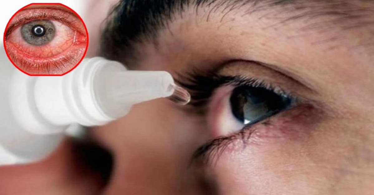 চোখ ওঠা রোগে আক্রান্তের সংখ্যা প্রতিনিয়ত বাড়ছে