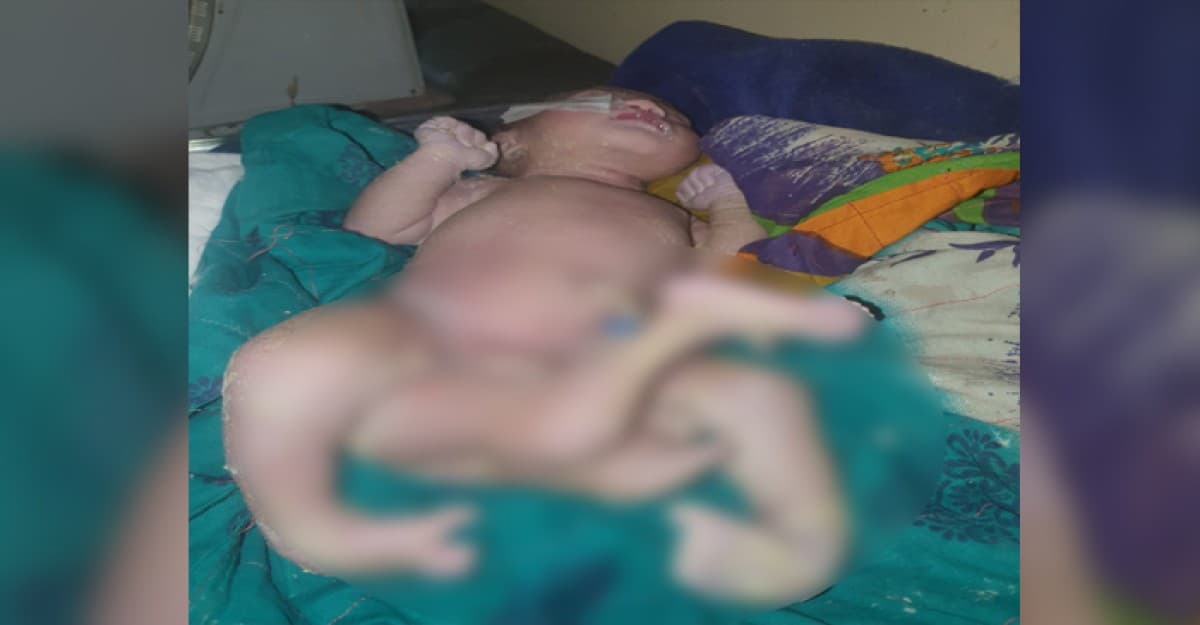মিরসরাইয়ে ৪ পা নিয়ে কন্যা শিশুর জন্ম
