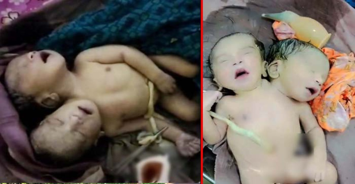 শার্শায় ২ মাথা নিয়ে শিশুর জন্ম